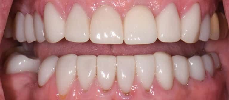 After Image: Porcelain Crowns and Bridges - front