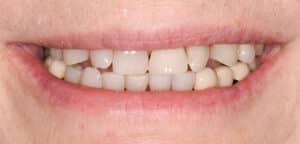Before Image: Porcelain Crowns and Bridges
