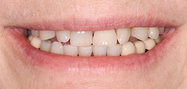 Before Image: Porcelain Crowns and Bridges - front