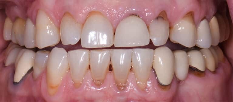 Before Image: Porcelain Crowns and Bridges - front