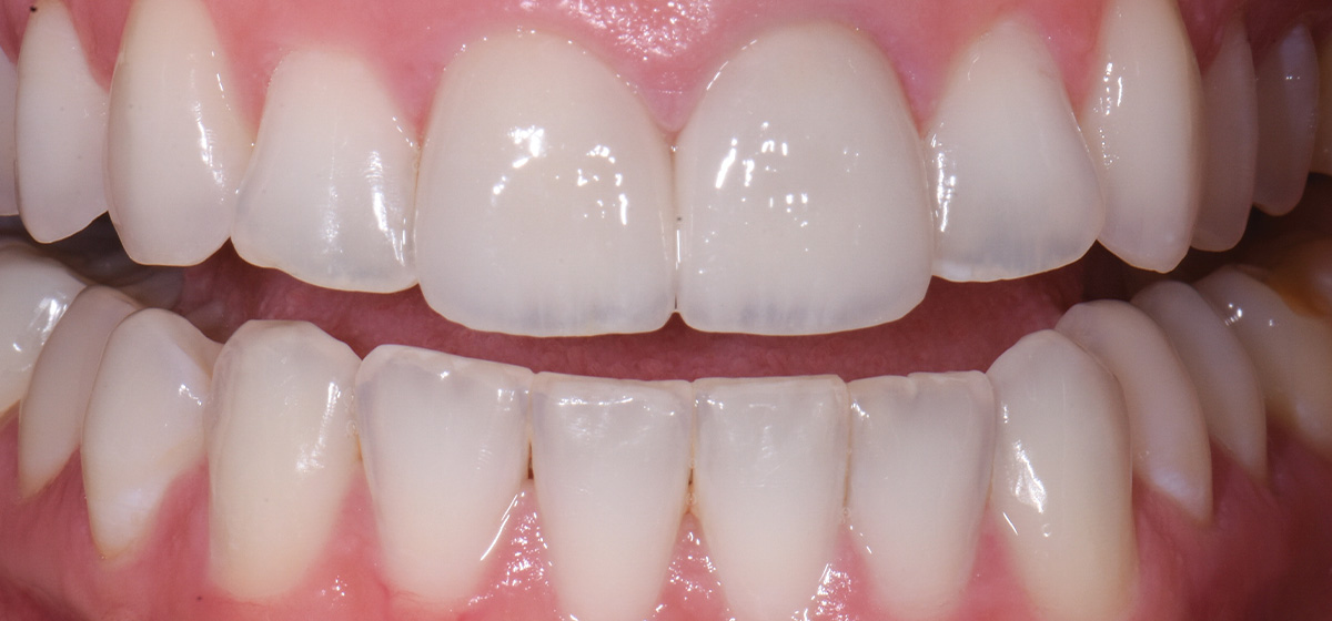 Advanced General Dentistry Case 3 After In Grandville Michigan