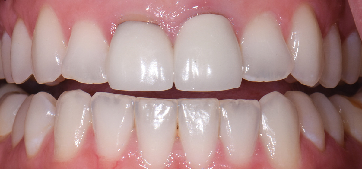 Advanced General Dentistry Case 3 Before In Grandville Michigan