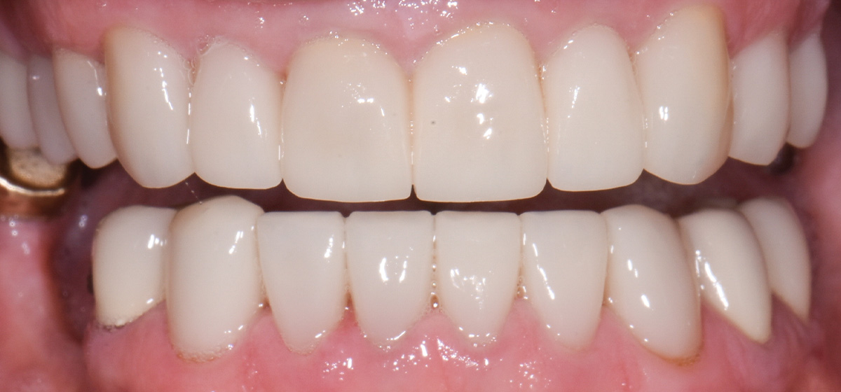 Dentures And Veneers Dentist In Grandville Mi