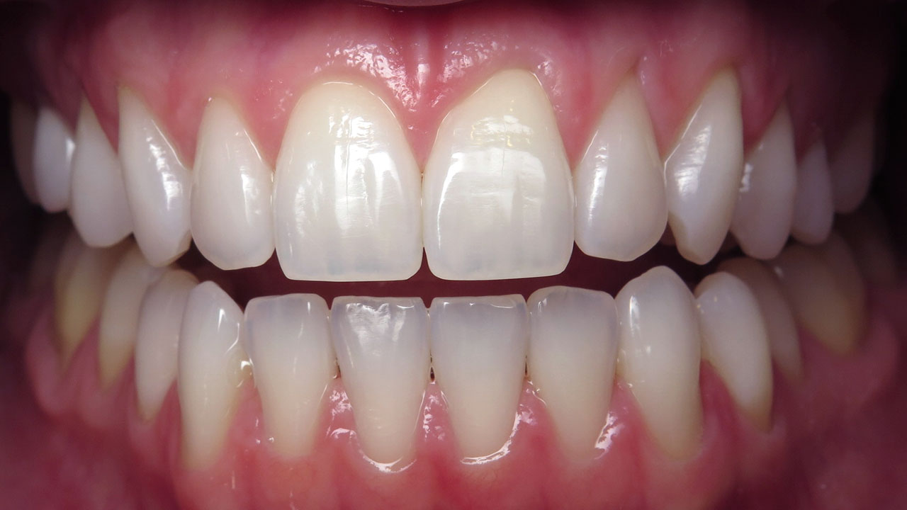 After Broken Front Teeth Trauma Grandville Mi