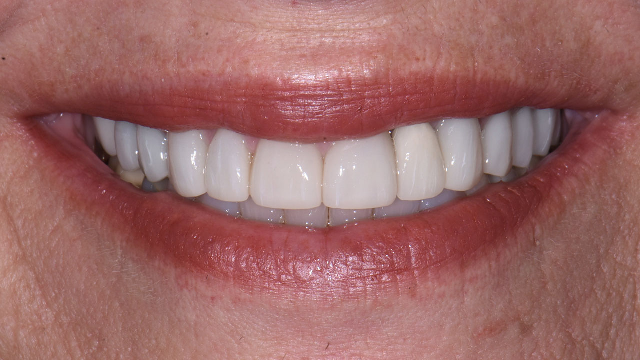 After Cosmetic Smile Makeover Grandville Mi