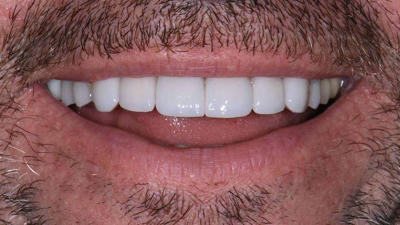 After Front Teeth All Ceramic Crowns Smile Grandville Mi