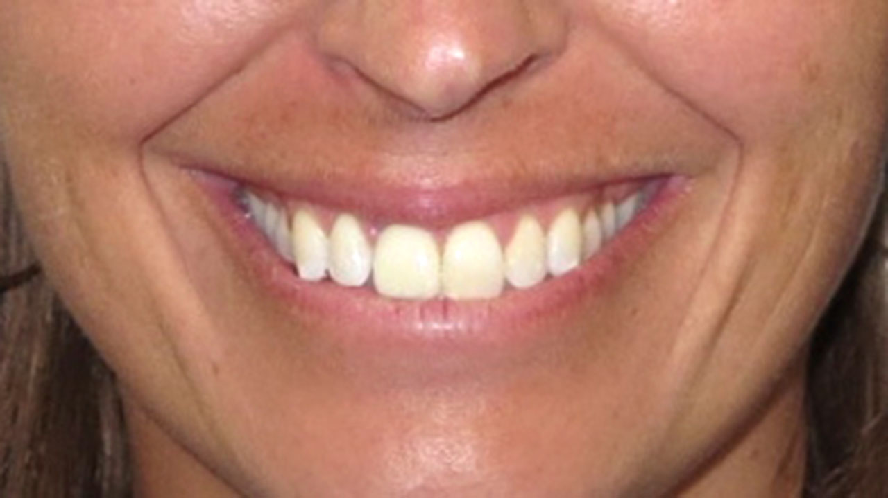 After Front Tooth Dental Implant Grandville Mi