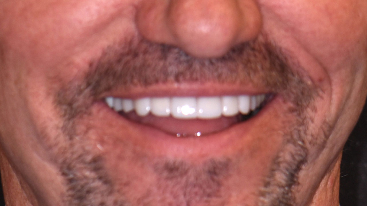 After Front Tooth Dental Implant Grandville Mi