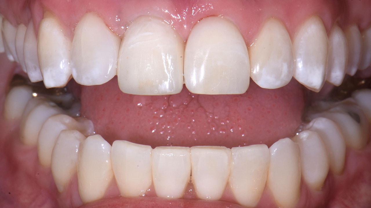 After Front Tooth Implant Close Up Grandville Mi