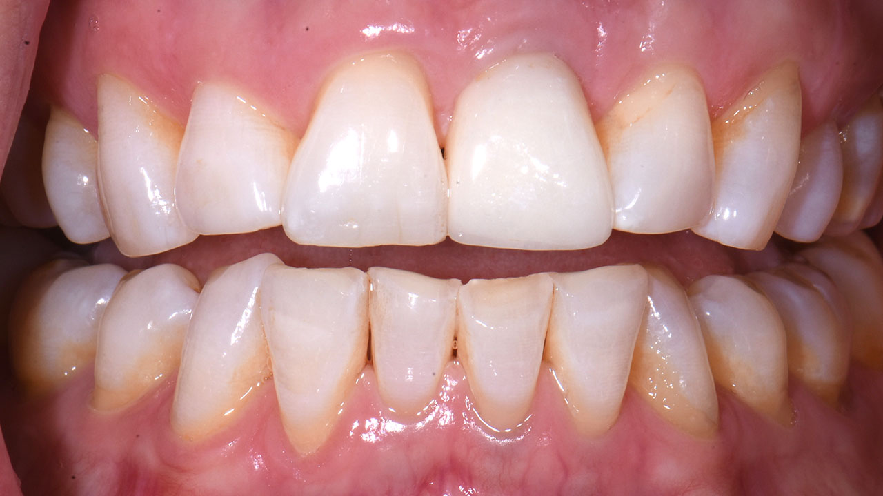 After Front Tooth Implant Close Up Grandville Mi