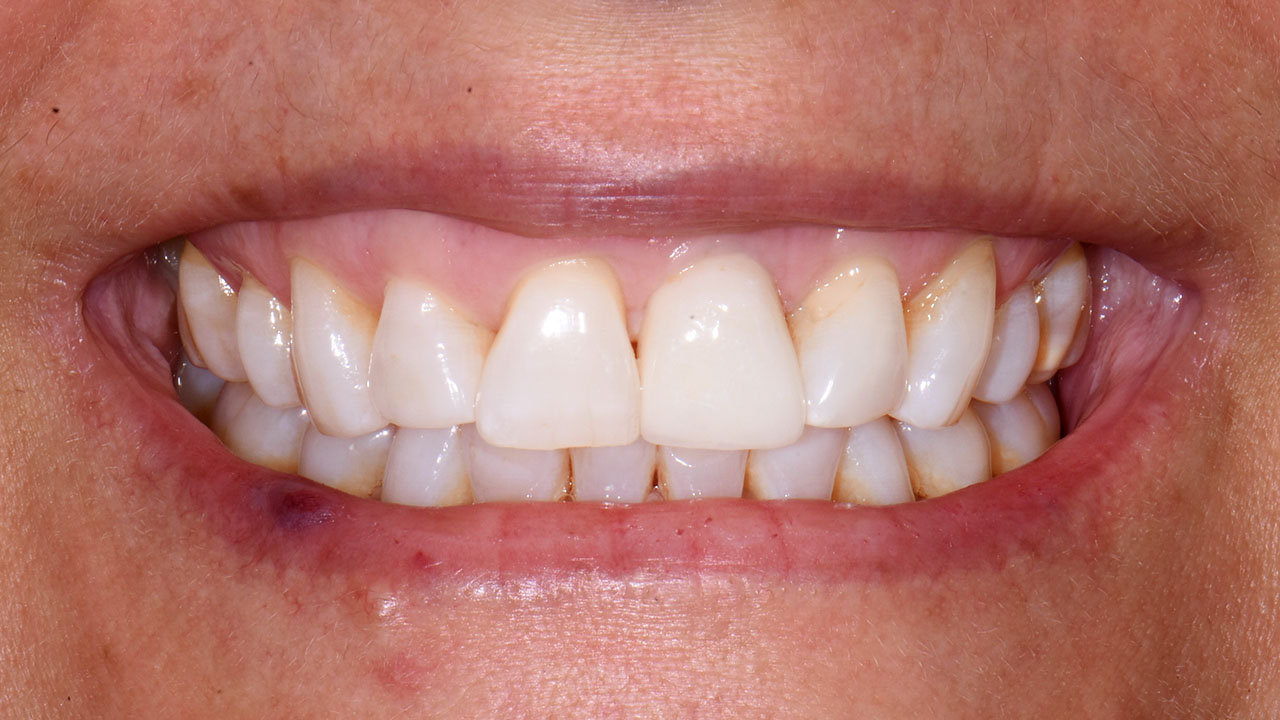 After Front Tooth Implant Smile Grandville Mi