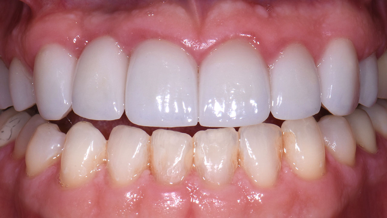 After Implant And Crowns Smile Grandville Mi