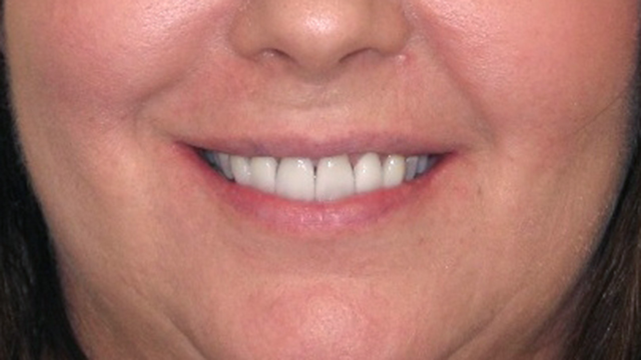 After New Porcelain Veneers Smile Grandville Mi