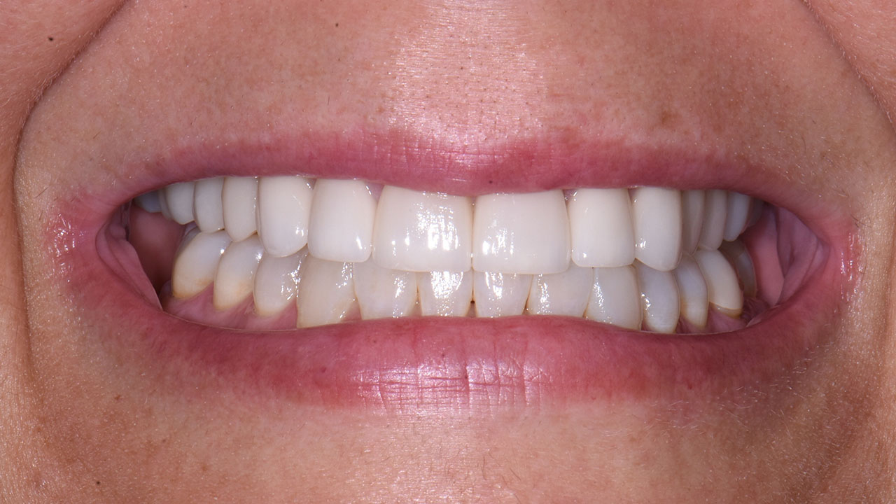 After Porcelain Veneers Aligned Front Teeth Grandville Mi