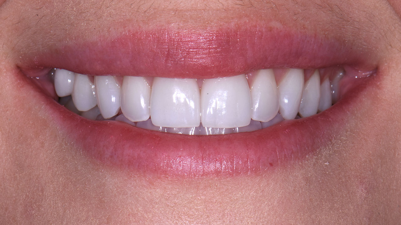 After Porcelain Veneers Repair Front Teeth Grandville Mi