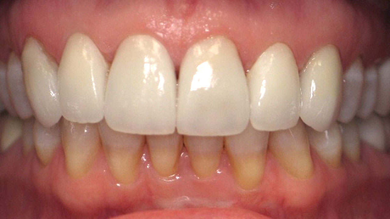 After Porcelain Veneers Retracted View Grandville Mi