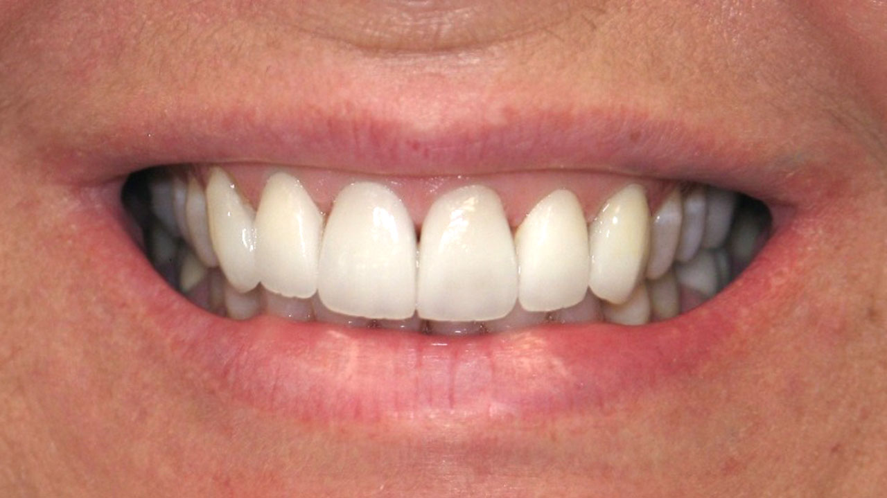 After Porcelain Veneers Smile Transformation Grandville Mi