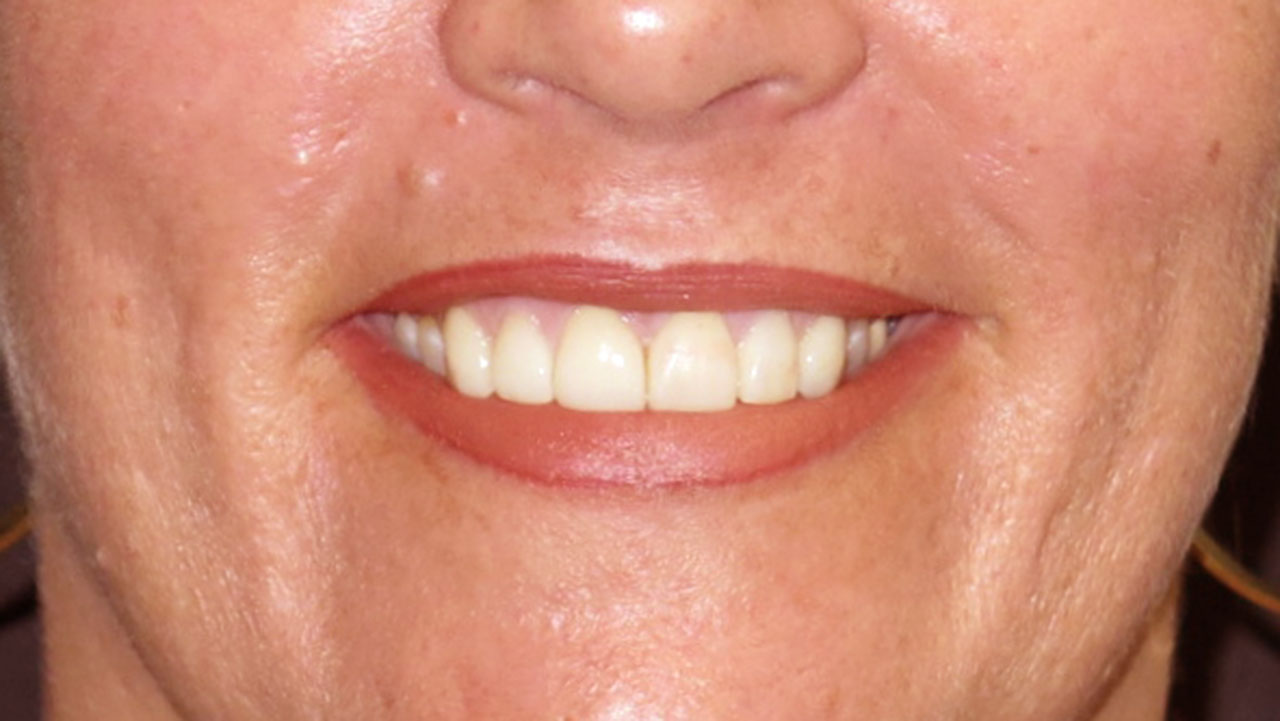 After Porcelain Veneers Smile Transformation Grandville Mi