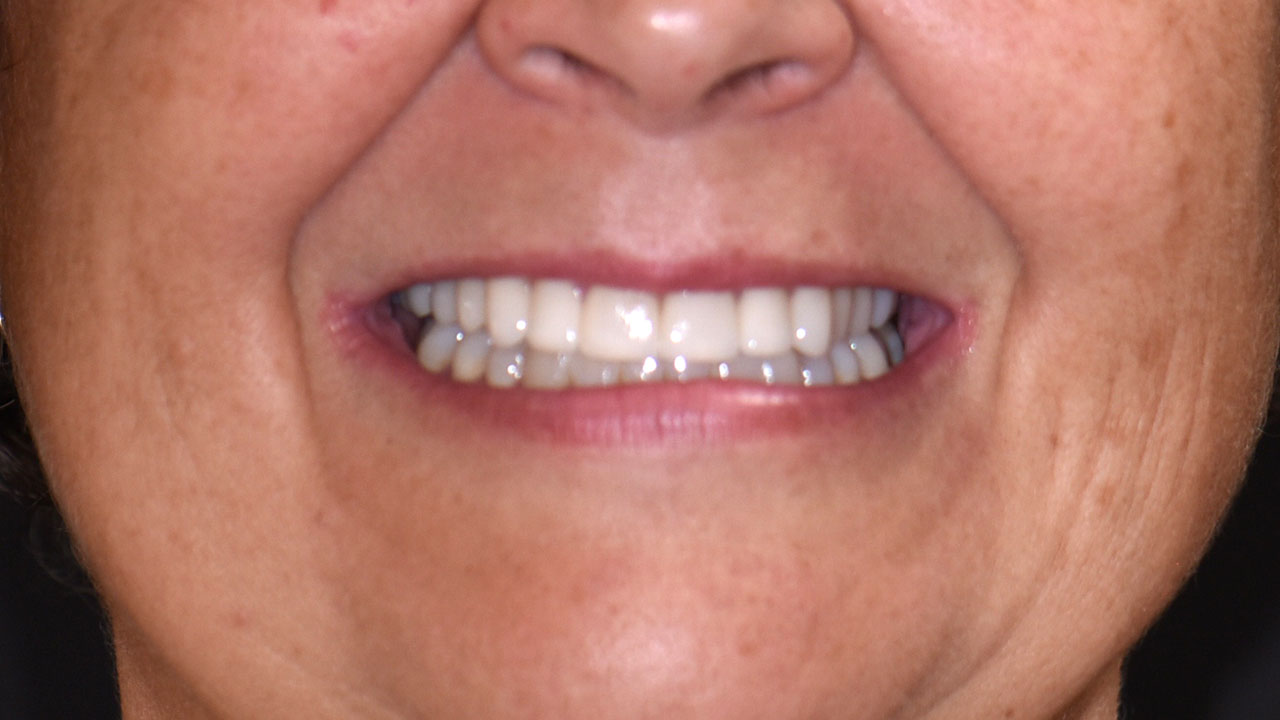 After Porcelain Veneers Smile Transformation Grandville Mi