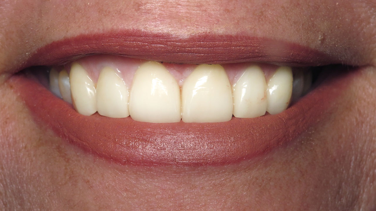 After Smile Porcelain Veneers Grandville Mi