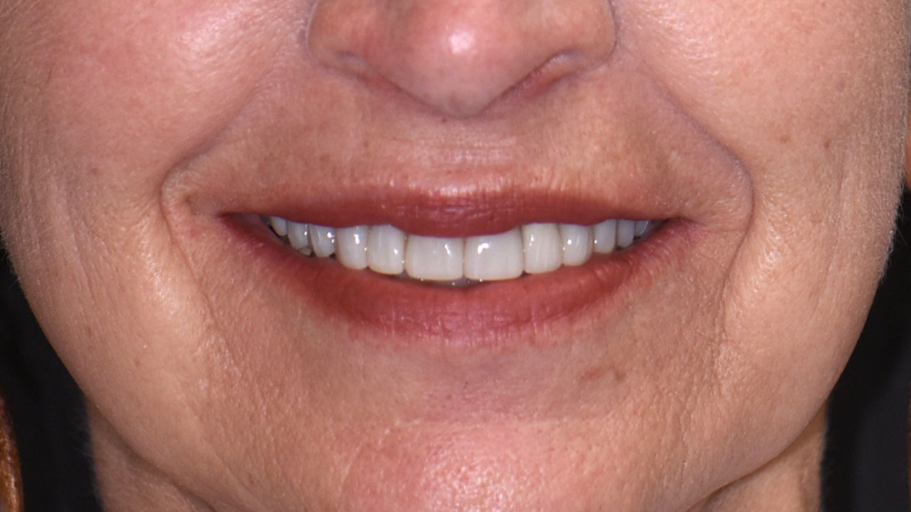 After Smile Veneers Crowns Implant Grandville Mi
