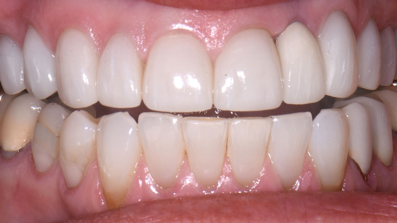 After Veneers And Crowns Front Teeth Grandville Mi