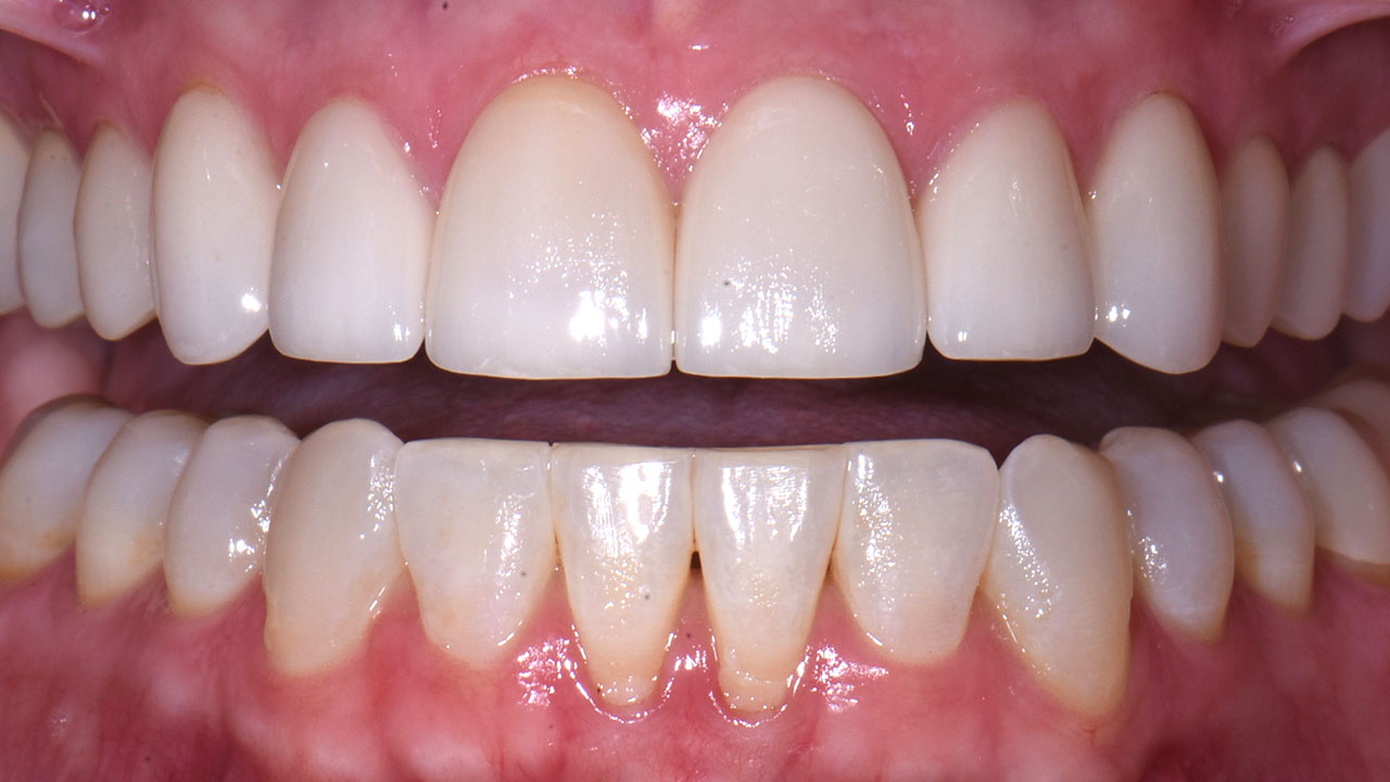 After Veneers Natural Smile Result Grandville Mi