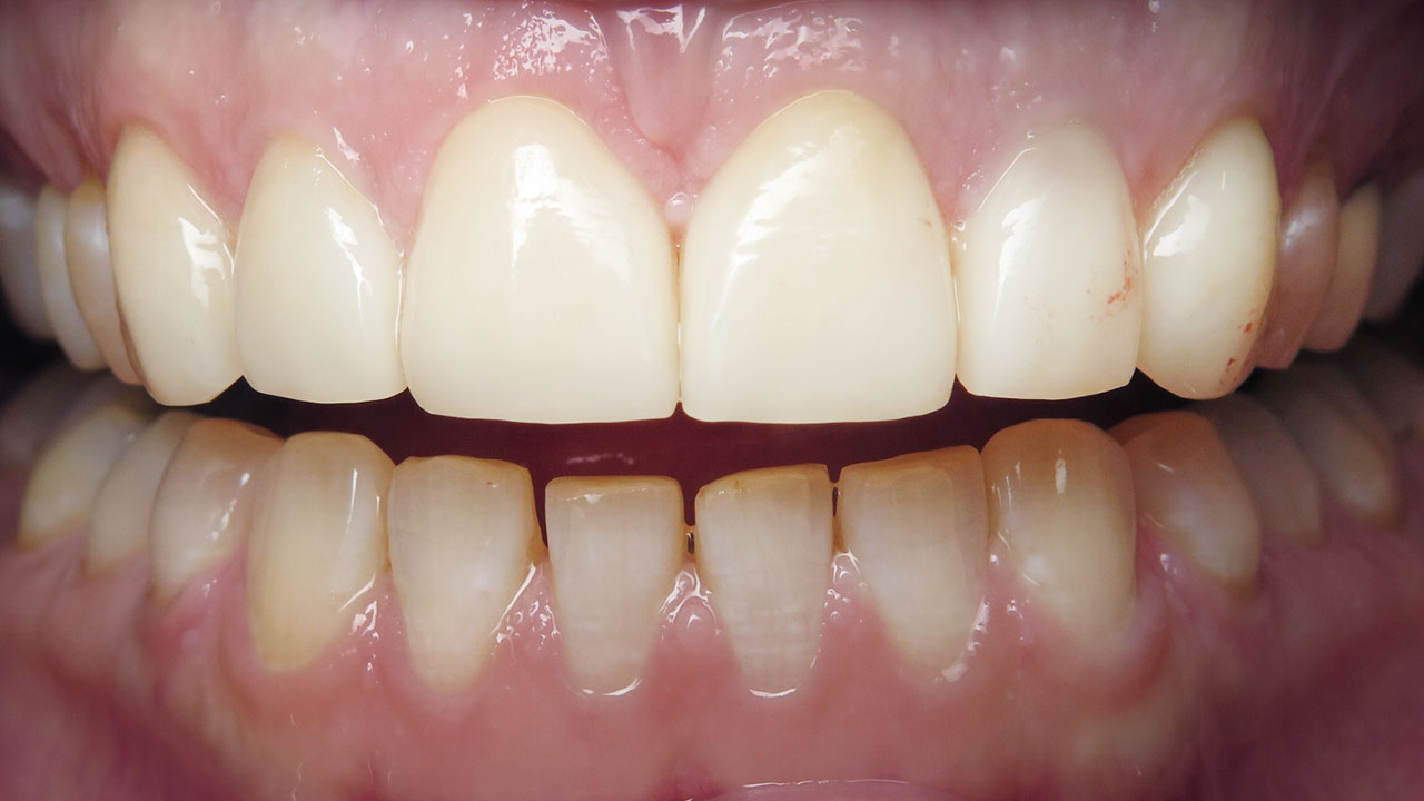 After Veneers Natural Tooth Proportions Grandville Mi