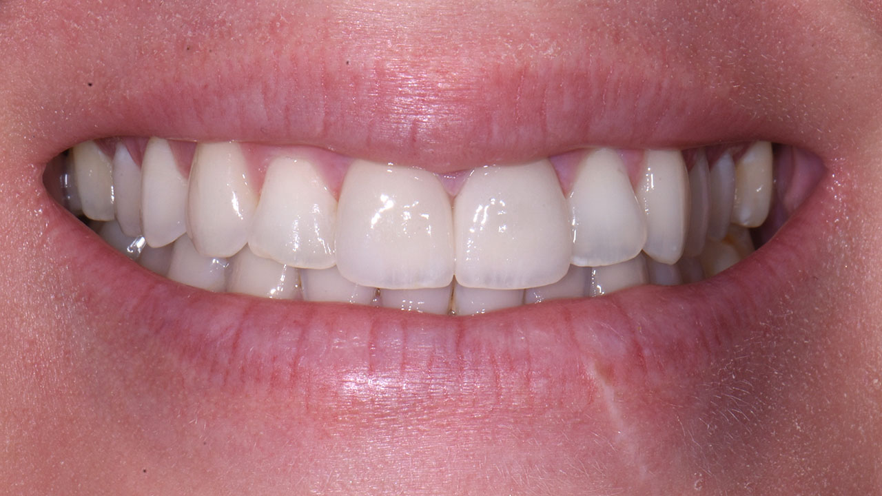 Anterior Crowns Childhood Trauma After Close Smile Grandville Mi