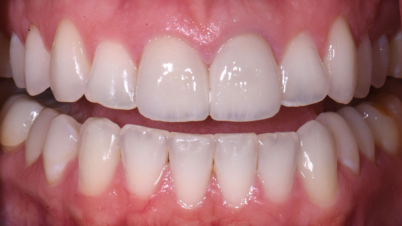 Anterior Crowns Childhood Trauma After Retracted Grandville Mi