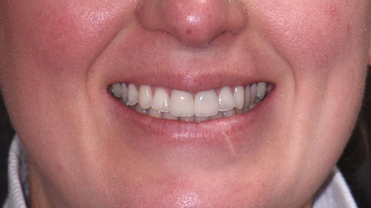 Anterior Crowns Childhood Trauma After Smile Grandville Mi