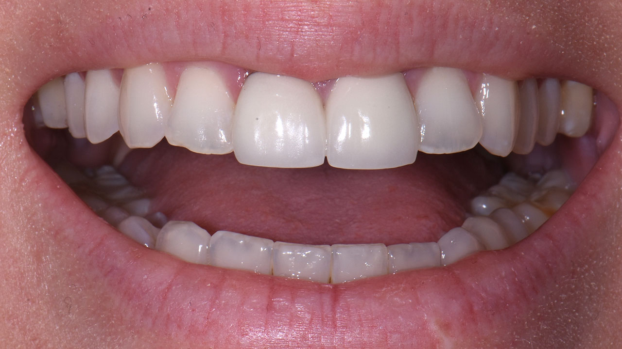Anterior Crowns Childhood Trauma Before Close Smile Grandville Mi
