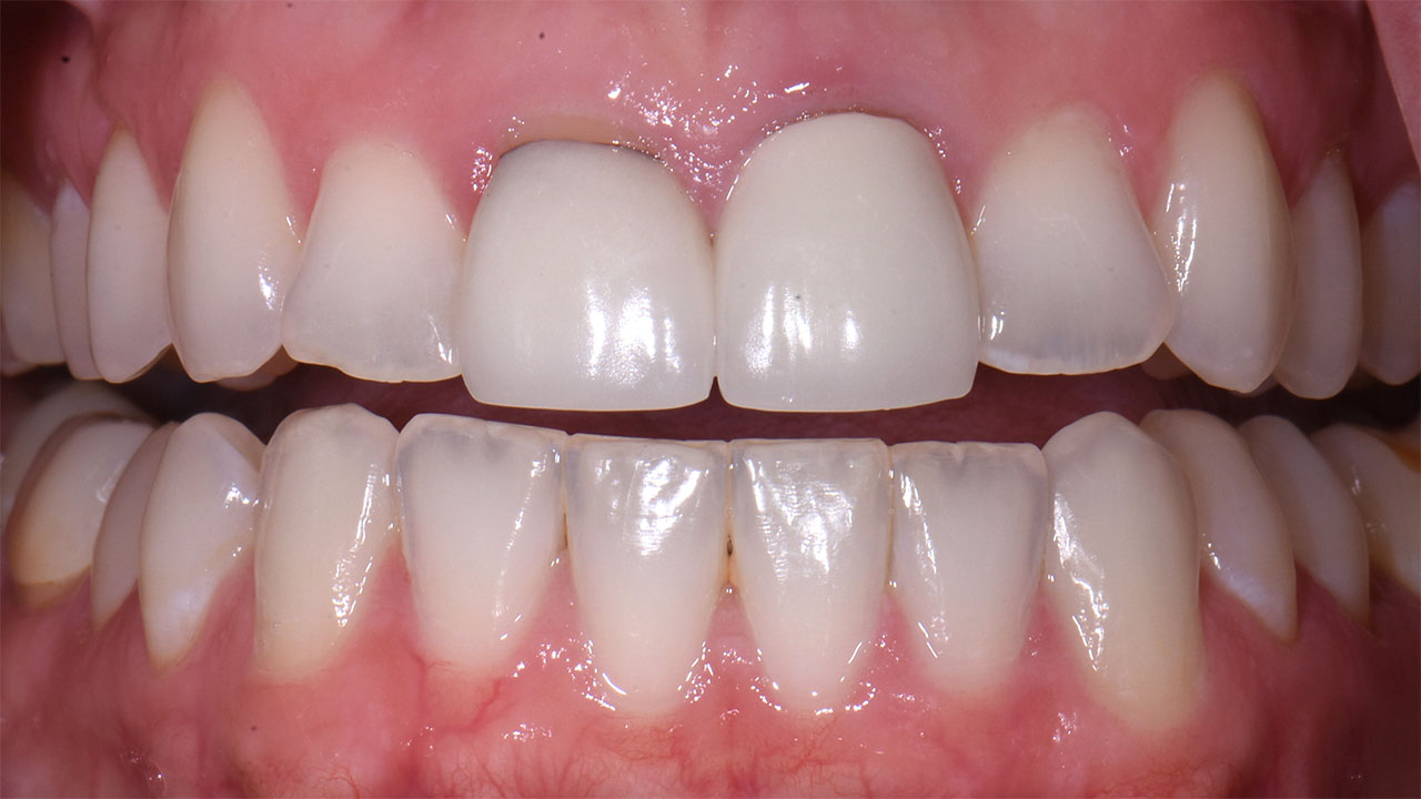 Anterior Crowns Childhood Trauma Before Retracted Grandville Mi