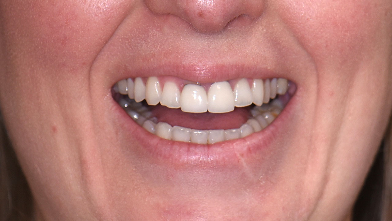 Anterior Crowns Childhood Trauma Before Smile Grandville Mi