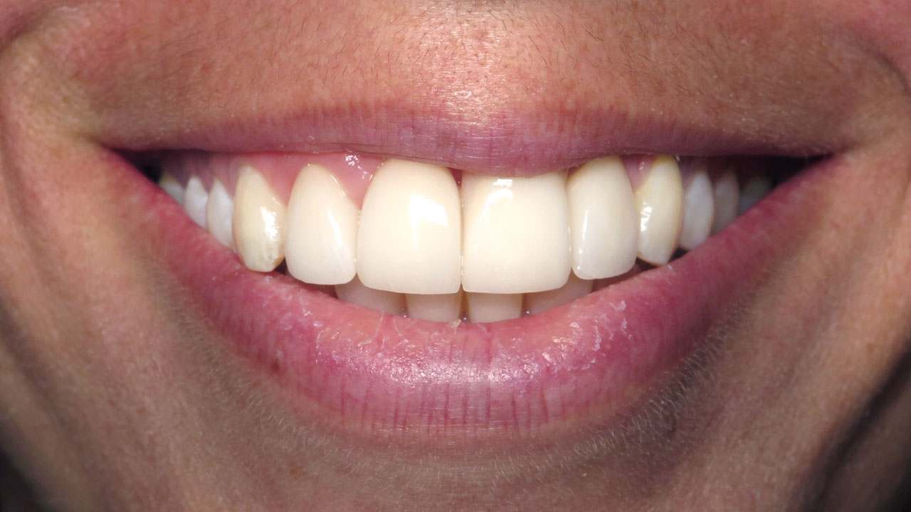 Anterior Crowns Dental Trauma After Close Smile Grandville Mi