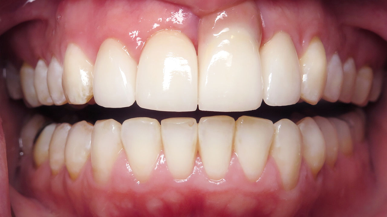 Anterior Crowns Dental Trauma After Retracted Grandville Mi