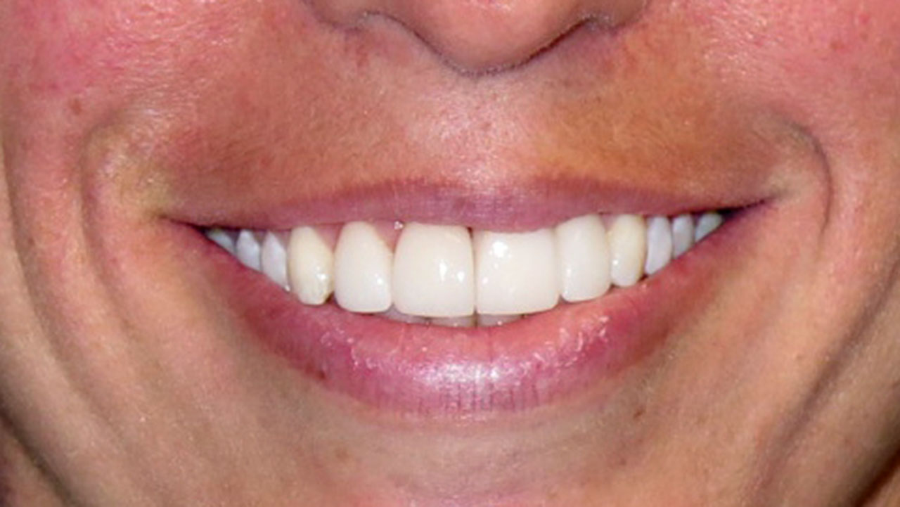 Anterior Crowns Dental Trauma After Smile Grandville Mi
