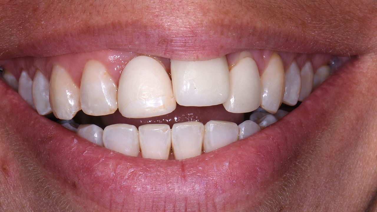 Anterior Crowns Dental Trauma Before Close Smile Grandville Mi