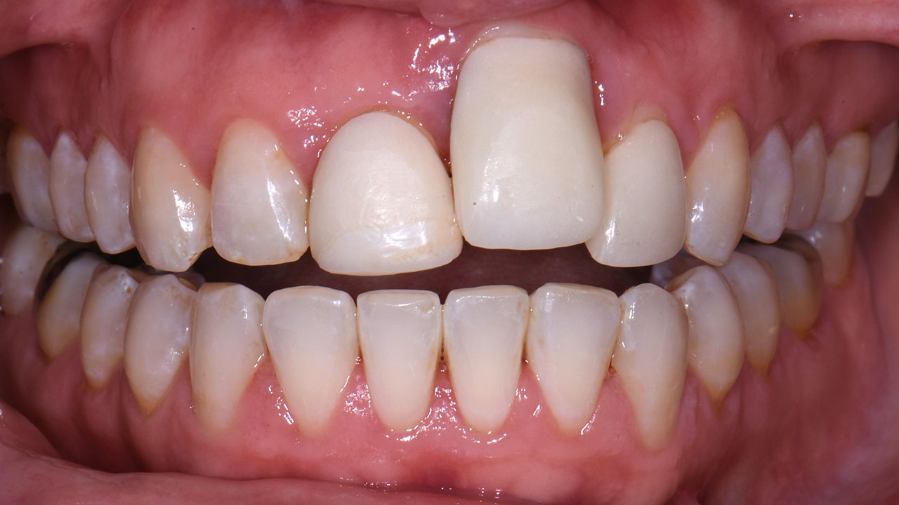 Anterior Crowns Dental Trauma Before Retracted Grandville Mi