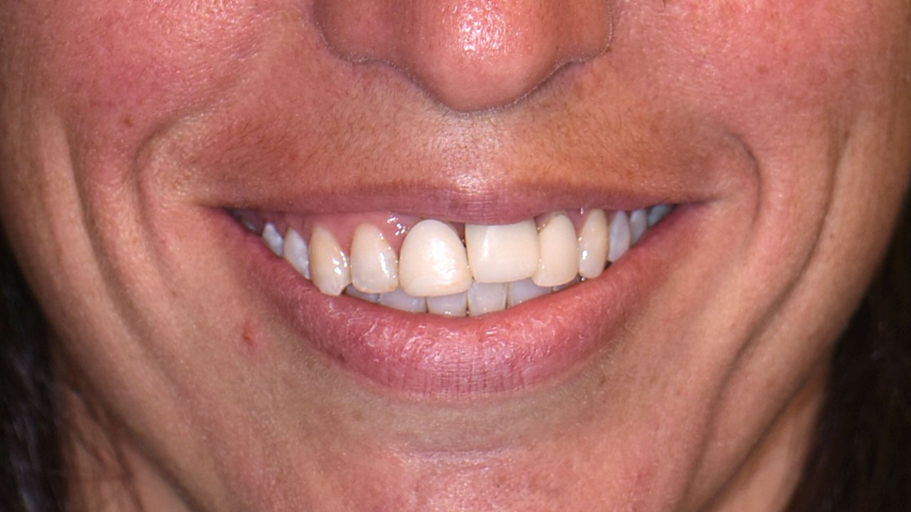Anterior Crowns Dental Trauma Before Smile Grandville Mi