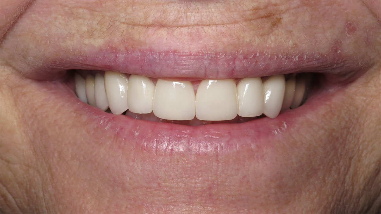 Anterior Crowns Discolored Fillings After Close Smile Grandville Mi