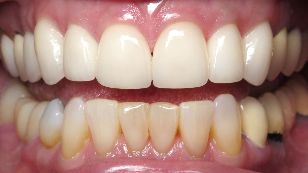 Anterior Crowns Discolored Fillings After Retracted Grandville Mi