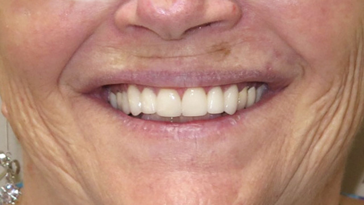 Anterior Crowns Discolored Fillings After Smile Grandville Mi