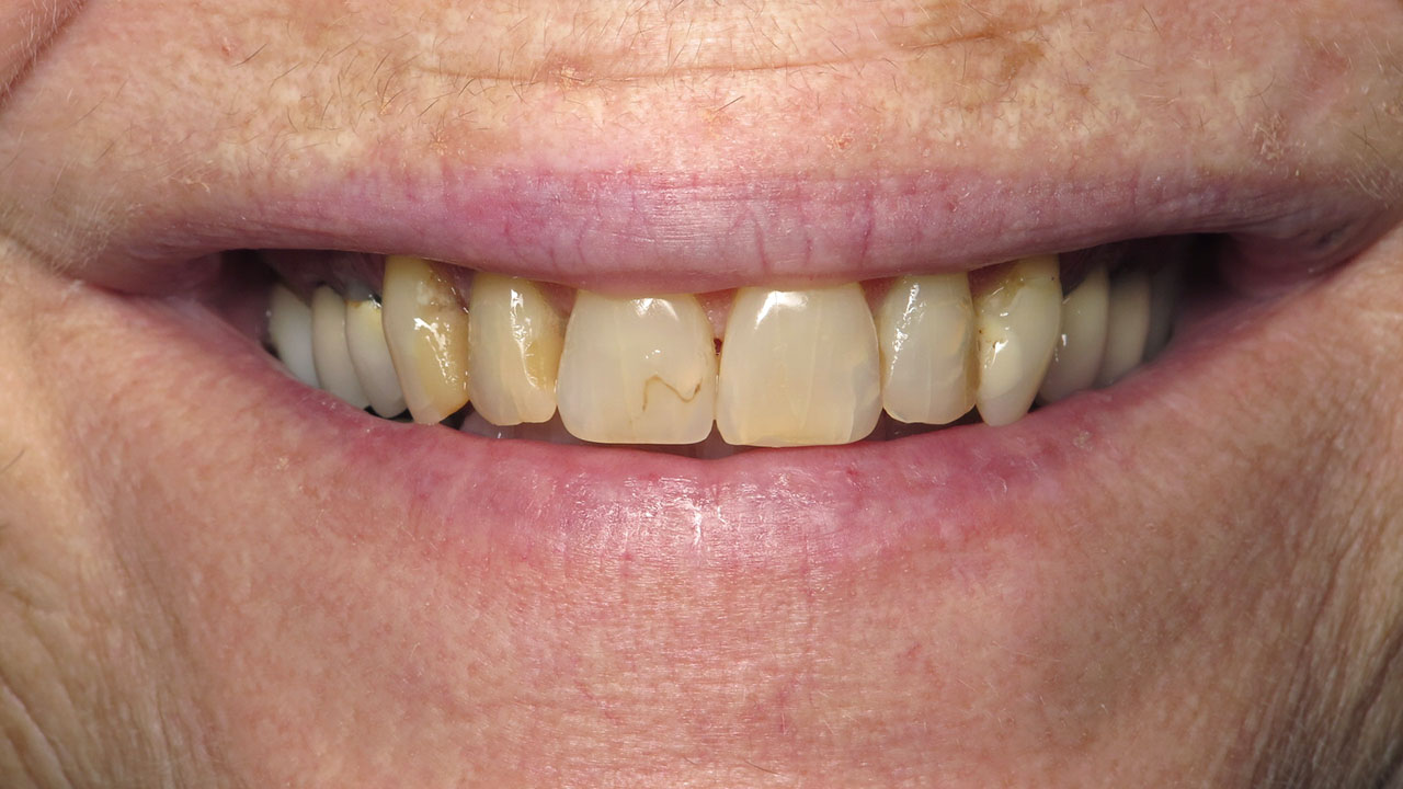 Anterior Crowns Discolored Fillings Before Close Smile Grandville Mi