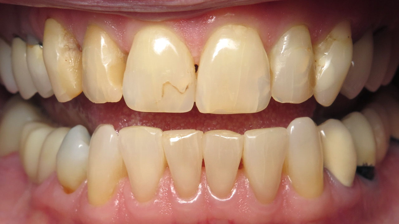 Anterior Crowns Discolored Fillings Before Retracted Grandville Mi