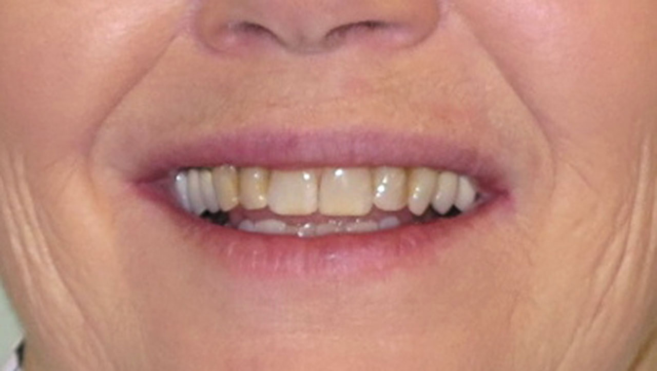 Anterior Crowns Discolored Fillings Before Smile Grandville Mi