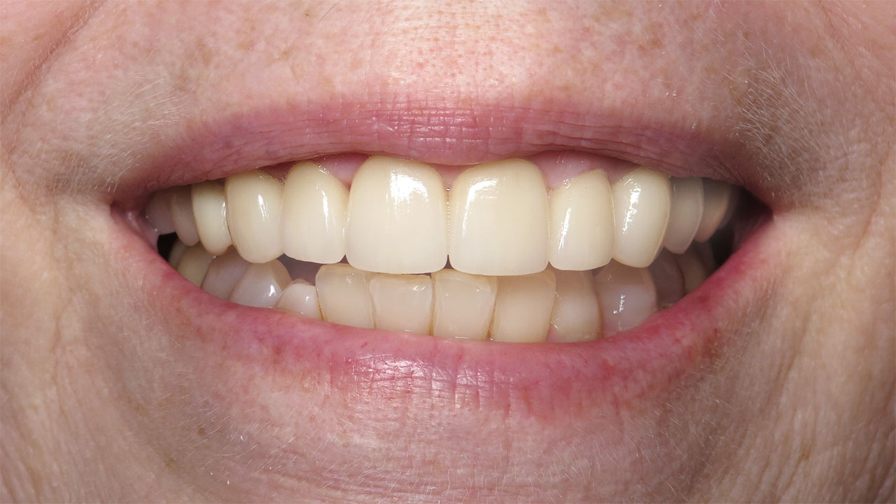 Anterior Crowns Large Fillings After Close Smile Grandville Mi