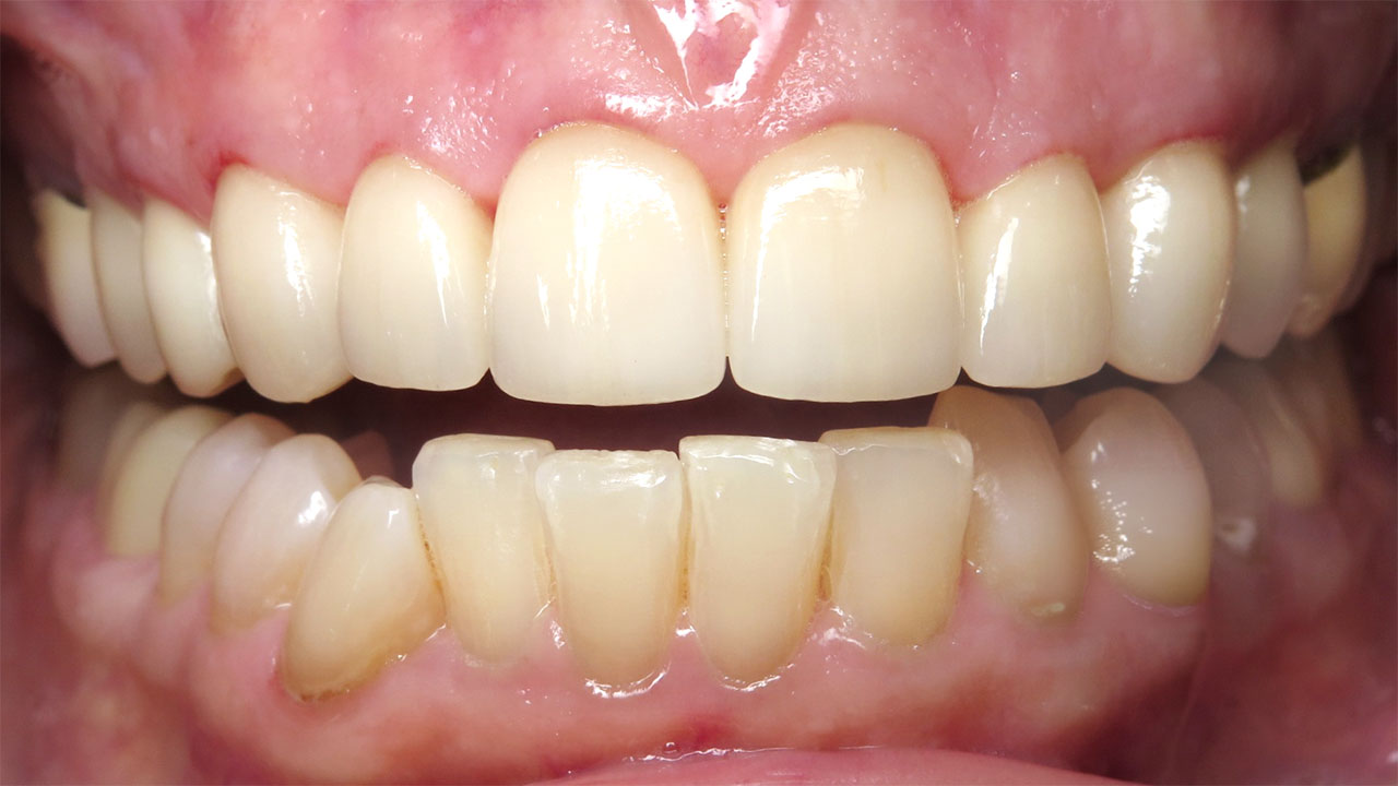Anterior Crowns Large Fillings After Retracted Grandville Mi