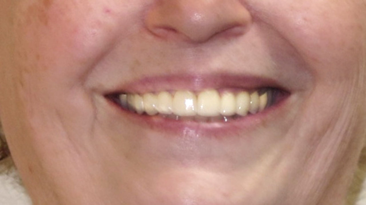Anterior Crowns Large Fillings After Smile Grandville Mi