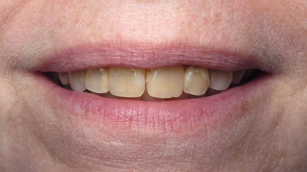 Anterior Crowns Large Fillings Before Close Smile Grandville Mi